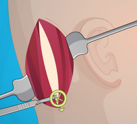 Kulak Ameliyatı